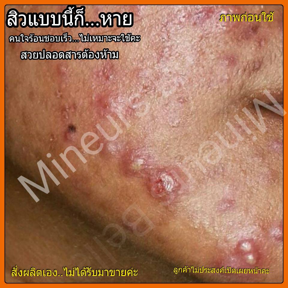 ครีมรักษาสิว
