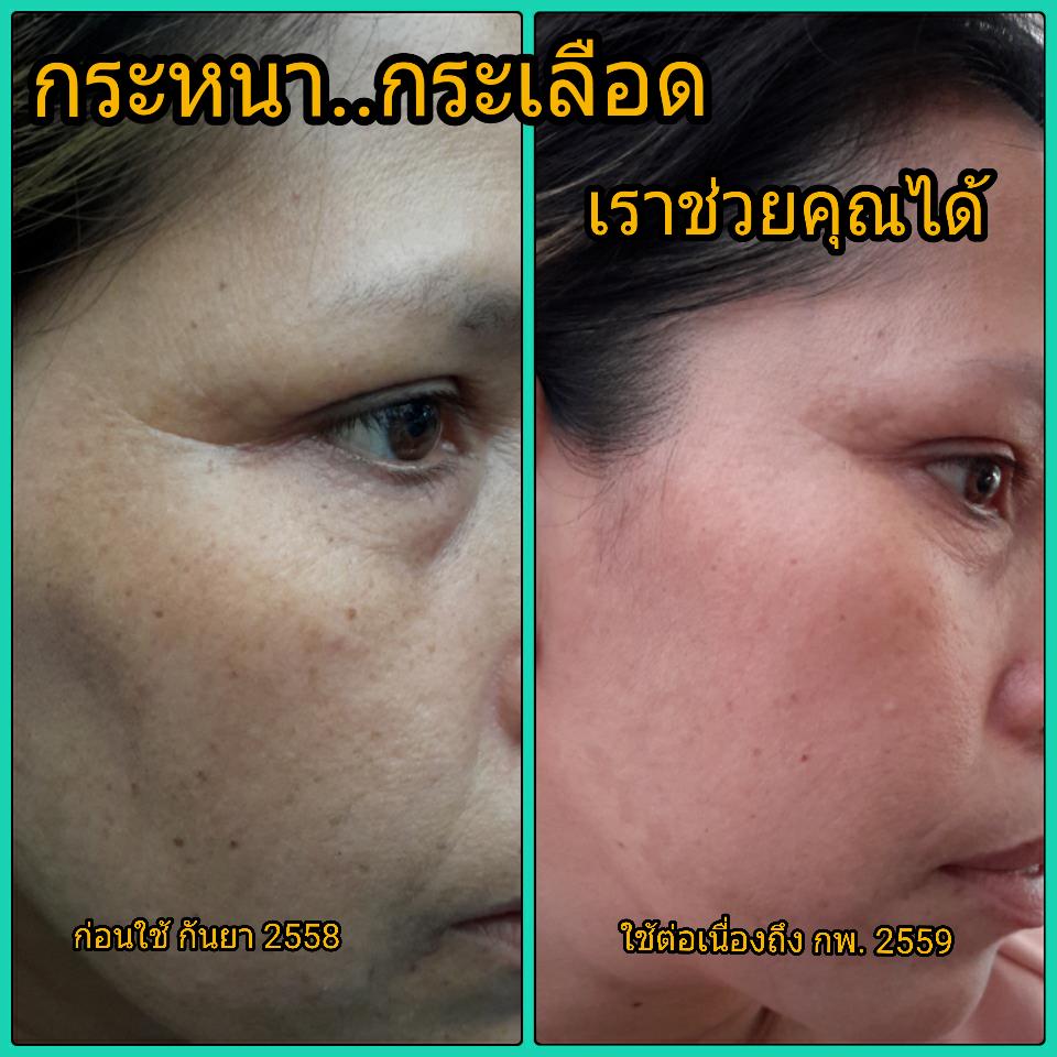 ครีมรักษากระ